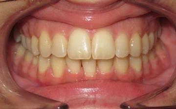 Case 9 - Missing lower incisor