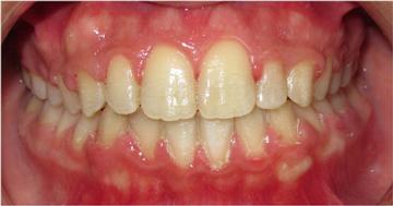 Case 10 - Crooked teeth aligned