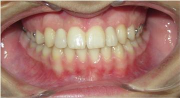 Case 13 - Missing upper laterals