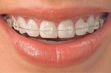 Treatment with Clear Braces