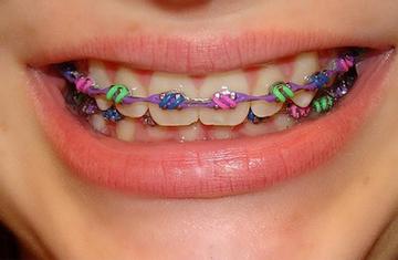 Treatment with Metal Braces