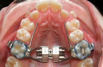 Treatment with Palatal Expander