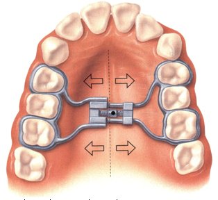 Treatment with Palatal Expander