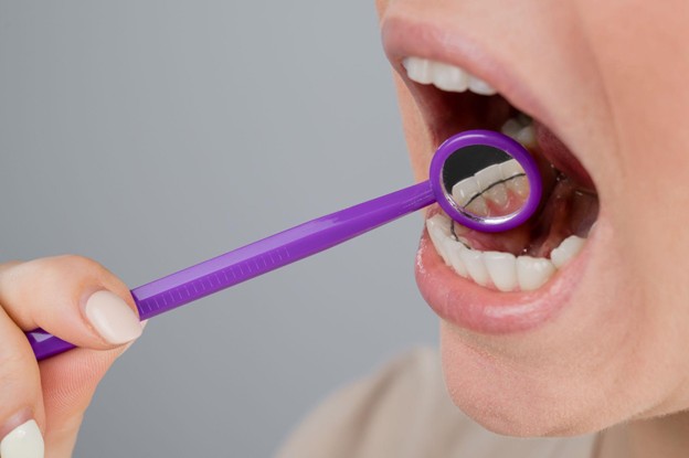 Μετά τα σιδεράκια:  Πώς να διατηρήσετε το νέο σας χαμόγελο