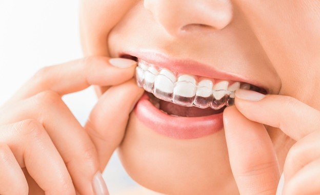 4 λόγοι γιατί το Invisalign είναι η τέλεια λύση για απασχολημένους ενήλικες
