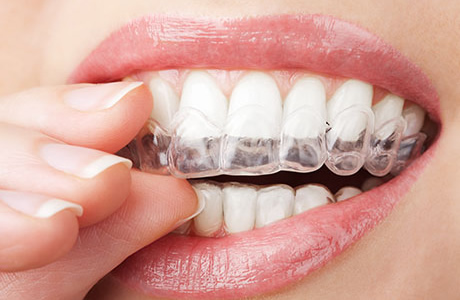 Treatment with Invisalign - Clear Aligners