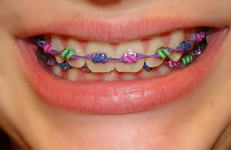 Treatment with Metal Braces