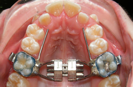 Treatment with Palatal Expander