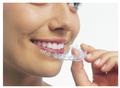 Treatment with Invisalign - Clear Aligners