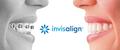 Treatment with Invisalign - Clear Aligners