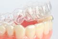 Treatment with Invisalign - Clear Aligners