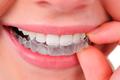 Treatment with Invisalign - Clear Aligners