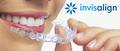 Treatment with Invisalign - Clear Aligners