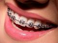 Treatment with Metal Braces